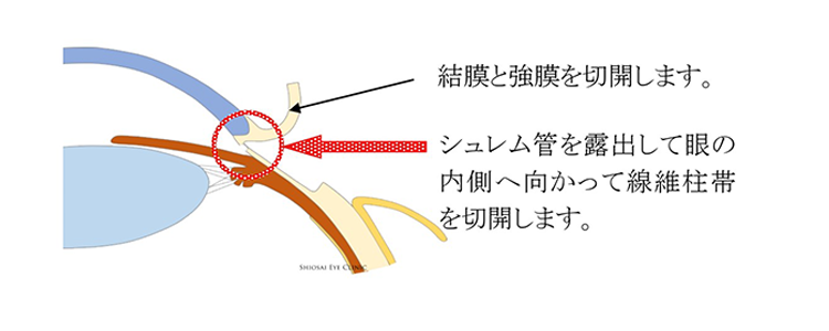 線維柱帯切開術（せんいちゅうたいせっかいじゅつ・眼外法） トラベクロトミー
