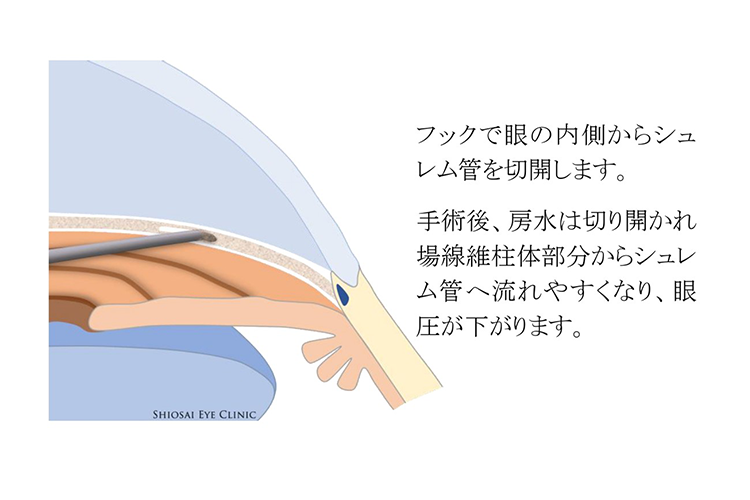 線維柱帯切開術（眼内法） マイクロフック トラベクロトミー