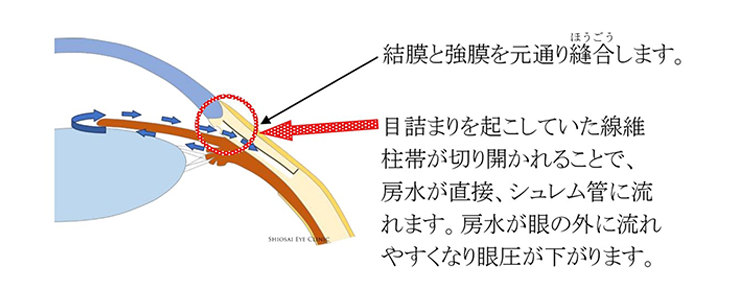 線維柱帯切開術（せんいちゅうたいせっかいじゅつ・眼外法） トラベクロトミー