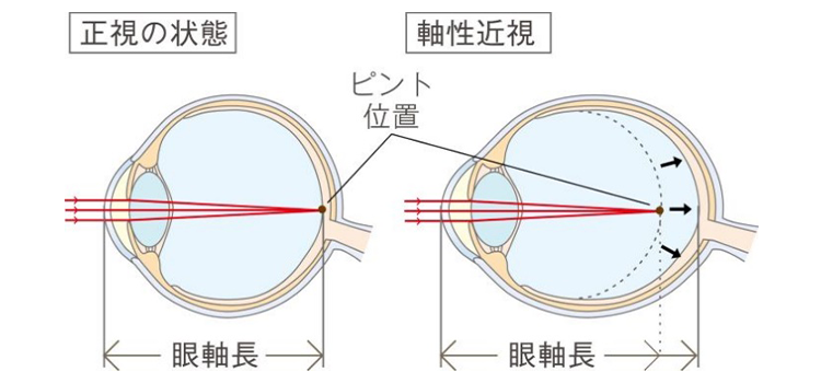 近視の原因